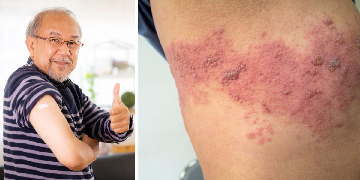 En man har vaccinerat sig och bältrosutslag på en rygg. Bältrosvaccin skyddar inte bara mot den smärtsamma sjukdomen bältros, det har i studier även visat sig skydda mot utvecklingen av demens.