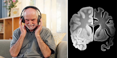 En man med hörlurar och en jämförelse mellan en frisk och en Alzheimersjuk hjärnhalva. I en studie har en enkel, billig och icke invasiv metod visat sig kunna hjälpa mot Alzheimers sjukdom.
