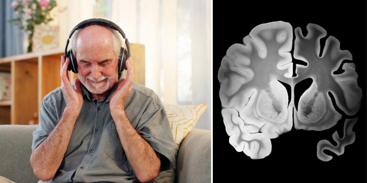 En man med hörlurar och en jämförelse mellan en frisk och en Alzheimersjuk hjärnhalva. I en studie har en enkel, billig och icke invasiv metod visat sig kunna hjälpa mot Alzheimers sjukdom.