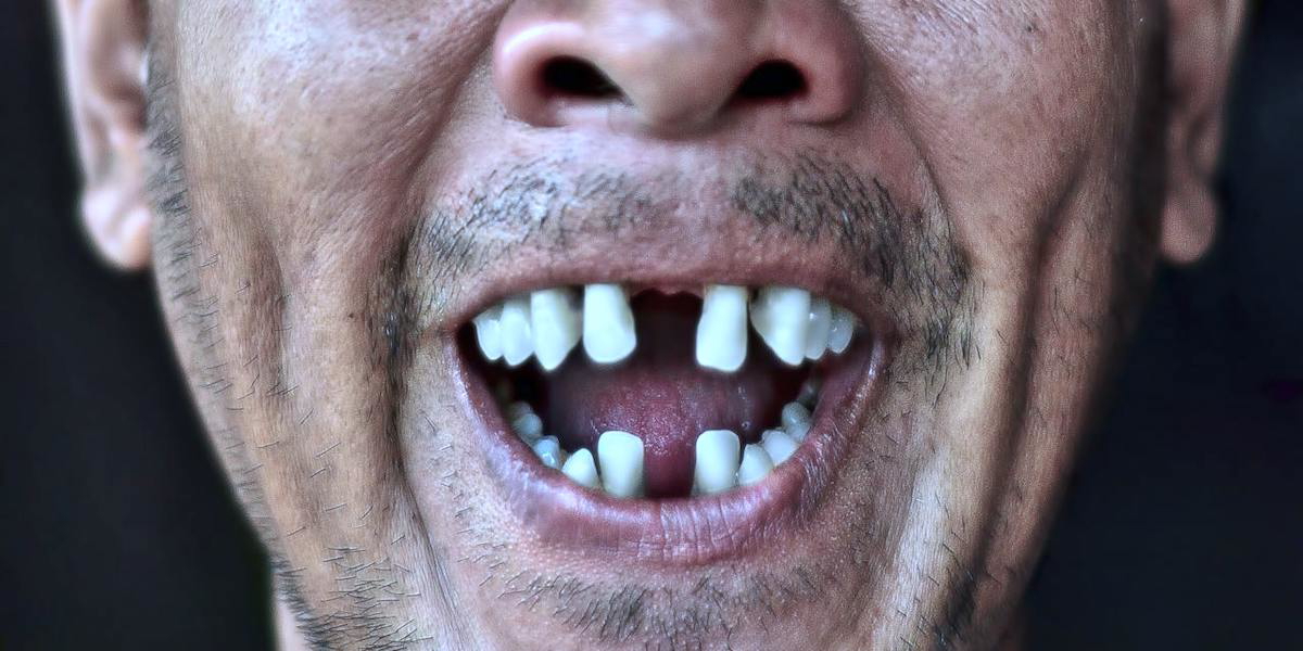 En man utan framtänder i över- och underkäken. En pensionär väntade in den nya tandvårdsreformen som ger alla som fyllt 67 billigare tandvård. Eftersom reformen täcker kronor, broar eller implantat långt fram i munnen kommer hans nya brygga kosta honom många tusen kronor mindre. Personen på bilden har ingenting med texten att göra.