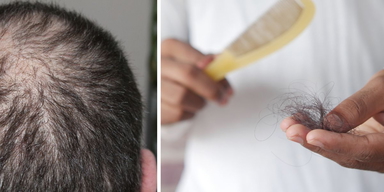 En man har håravfall