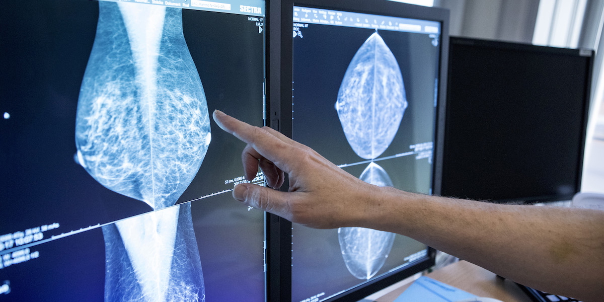 En läkare tittar på bröströntgenbilder, mammografibilder. När inte bara läkare, utan även AI, granskar mammografibilder missas färre fall av bröstcancer, det visar en stor svensk studie.