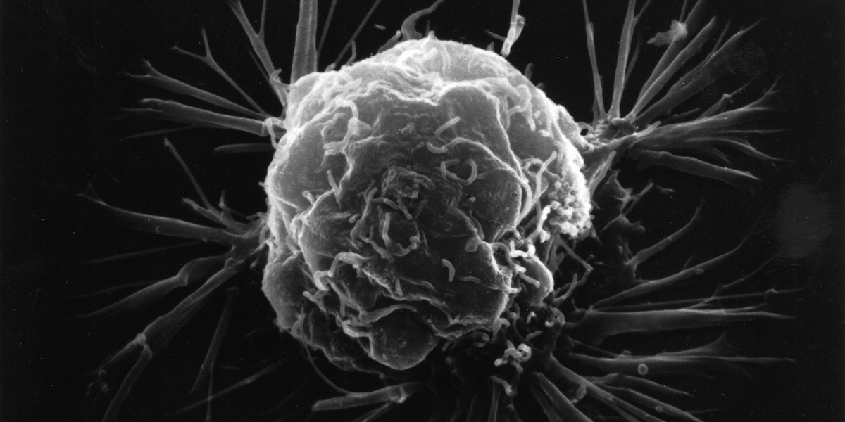 En bröstcancercell fotograferad med ett svepelektronmikroskop. Forkarre har nu hittat ett sätt att få bakterier att äta upp hela cancertumörer inifrån.