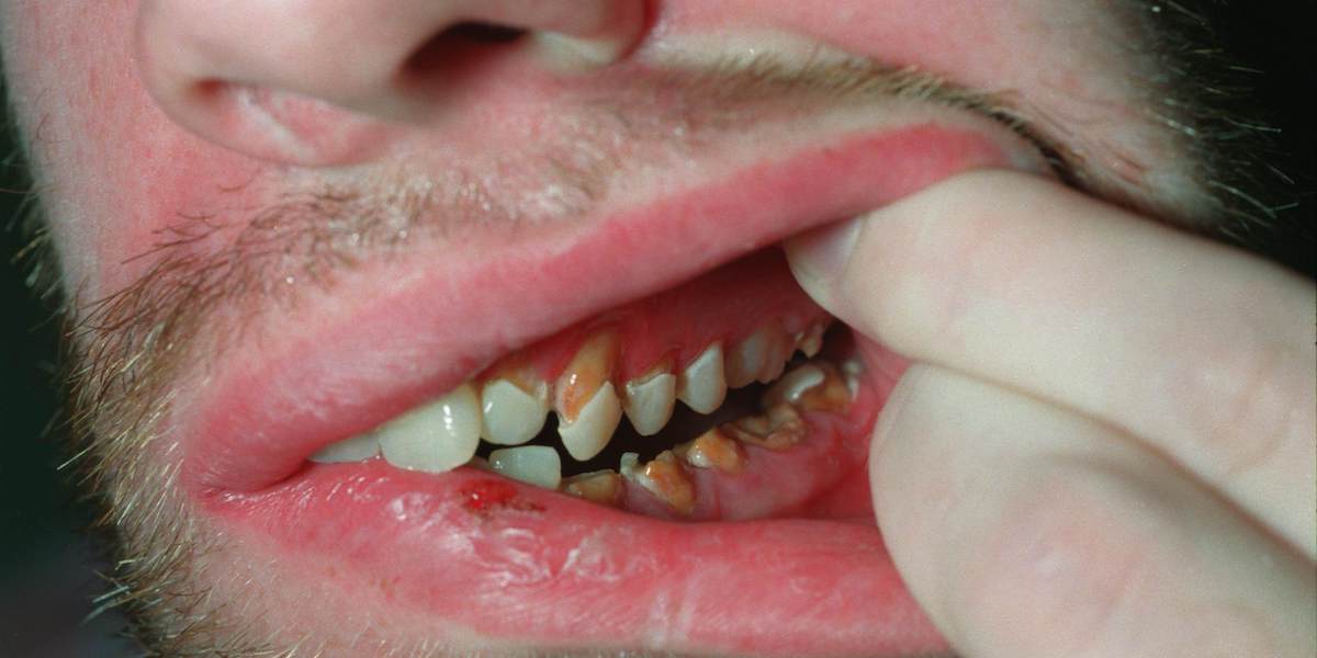 Man med karies och tandlossning.